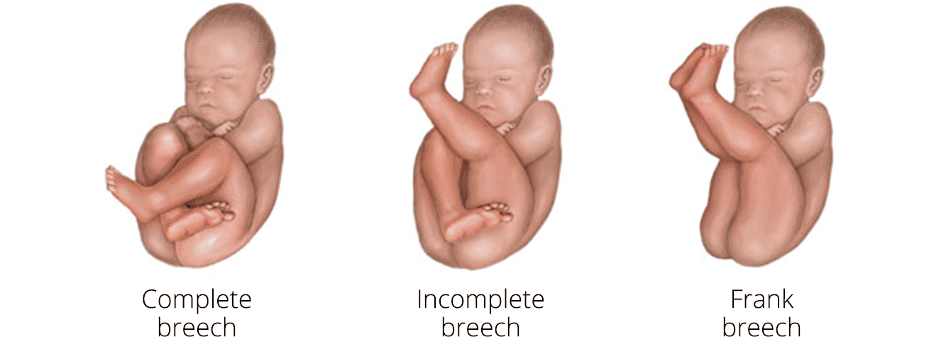 breech presentation in the pregnancy