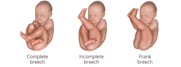 breech baby positions