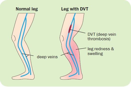 DVTlegimage.JPG — Chelsea and Westminster Hospital NHS Foundation Trust