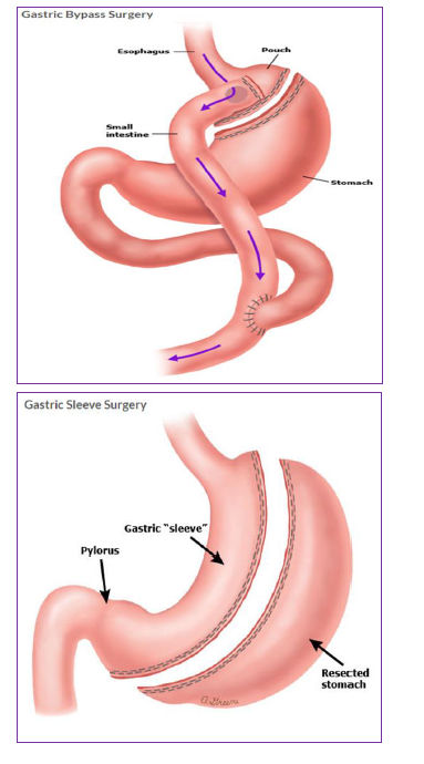 Gastric Sleeve Surgery - Health Library