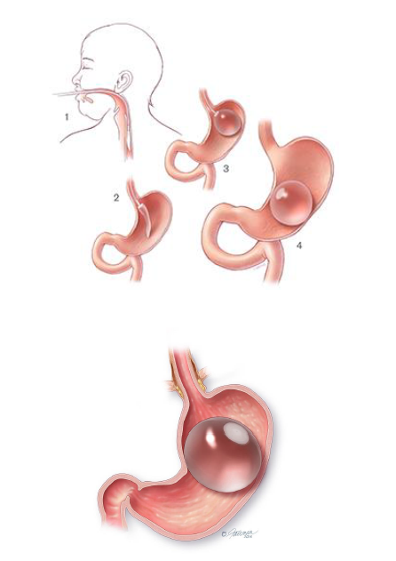 Dietary Guidance after Intra-gastric Balloon Insertion — Chelsea
