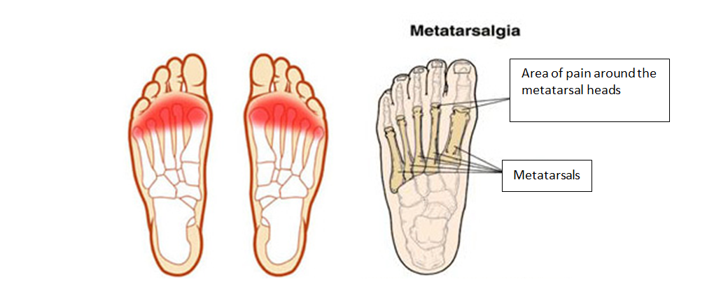 Metatarsalgiaanddislocatedtoedeformities.PNG — Chelsea and Westminster ...