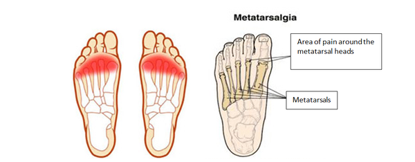 Big Toe Sprain - Foot - Conditions - Musculoskeletal - What We Treat 