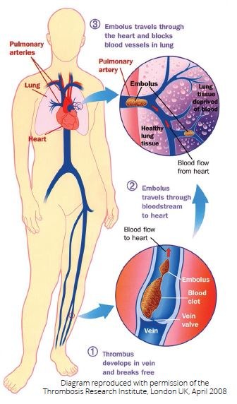 Risk Factors and Complications from Blood Clots