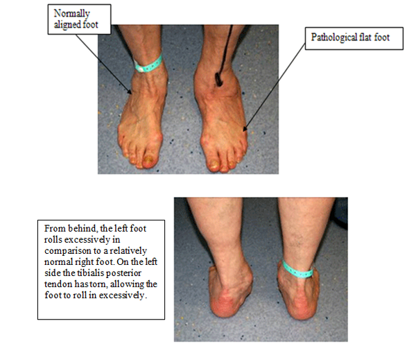 Flexible flatfoot: Foot orthoses and outcomes