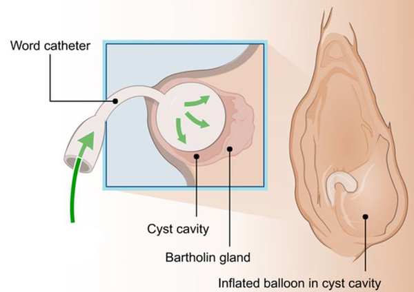 Word catheter for Bartholin's abscess — Chelsea and Westminster