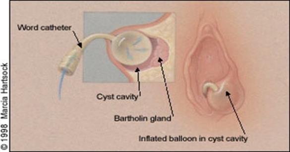 Bartholin's cyst and abscess treatment - GYNECOLOGY